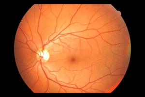 Normal Retina Fundus